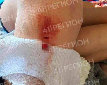 Семье ребенка, которого покусала собака, выплатят компенсацию